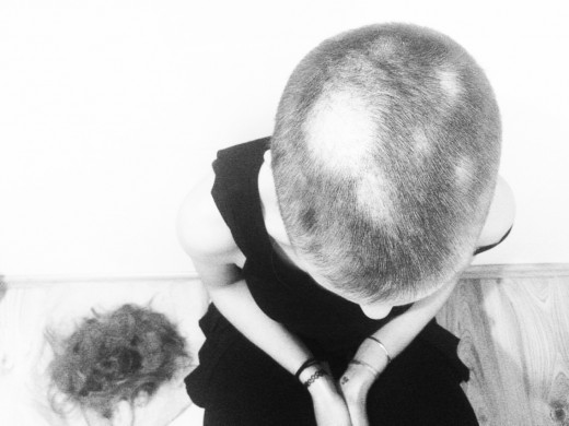 Alopecia Areata